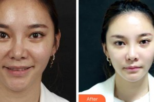 阜陽東方美萊塢醫(yī)療美容醫(yī)院劉洪魁整形價格表附埋線提升案例展示