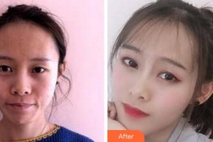 阜陽楊鈞美容整形門診部楊利整形價格表附埋線提升案例展示