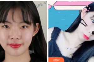 阜陽婦女兒童醫(yī)院整形美容外科李忠民整形價格表附熱瑪吉案例展示