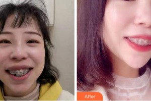 阜陽愛齒口腔門診部李豐整形價格表附金屬托槽矯正案例展示