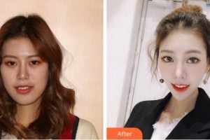 阜陽愛齒口腔門診部李文超整形價格表附隱形托槽矯正案例展示