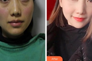 阜陽七院愛爾眼科醫(yī)院姚艷芳整形價格表附激光去眼袋案例展示