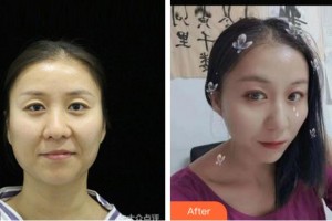 阜陽七院愛爾眼科醫(yī)院馬頌章整形價格表附眼部修復(fù)案例展示