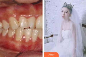 阜陽愛齒口腔門診部楊靜靜整形價格表附牙齒隱形矯正案例展示