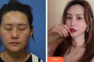 阜陽福田眼科醫(yī)院丁健整形價格表附埋線雙眼皮案例展示