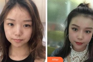 阜陽華山醫(yī)院眼科程光輝整形價格表附開內(nèi)眼角案例展示