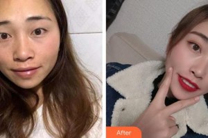 宿州天使醫(yī)療美容門診部曹龍整形價格表附雙眼皮案例展示