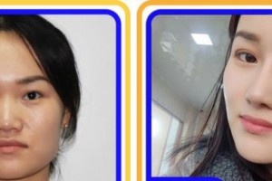 宿州美萊醫(yī)療美容醫(yī)院李培德整形價格表附鼻部整形案例展示