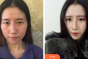 宿州漢密爾頓醫(yī)學(xué)美容醫(yī)院方明松整形價格表附鼻修復(fù)案例展示