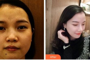 宿州陽光醫(yī)療美容醫(yī)院王武整形價格表附隆鼻案例展示