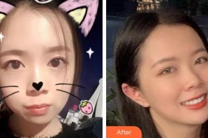 宿州利美口腔診所何艷玲整形價格表附金屬托槽矯正案例展示