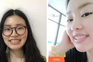 宿州醫(yī)美佳人醫(yī)療美容醫(yī)院徐文龍整形價格表附口腔矯正案例展示