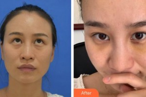 宿州市第一人民醫(yī)院眼科曹天龍整形價格表附祛眼袋案例展示