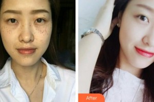 巢湖麗膚中西醫(yī)結(jié)合門診部醫(yī)療美容科程友軍整形價格表附祛斑案例展示