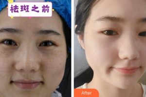 六安市人民醫(yī)院醫(yī)學(xué)美容中心邢紅整形價格表附祛斑案例展示