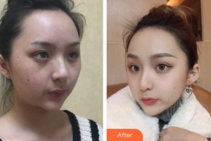 六安市人民醫(yī)院醫(yī)學(xué)美容中心余培銀整形價格表附祛斑案例展示