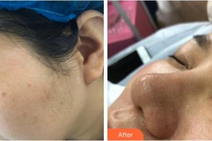 六安伊而美醫(yī)療整形美容醫(yī)院畢星星整形價格表附嫩膚案例展示