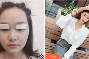 六安市第六人民醫(yī)院眼科佘傳應(yīng)整形價格表附眼部案例展示