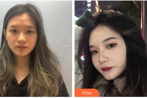 六安市中醫(yī)院眼科嚴(yán)靜整形價格表附眼部整形案例展示