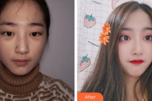 亳州愛爾眼科醫(yī)院余紹軍整形價格表附激光去眼袋案例展示