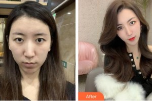 亳州愛爾眼科醫(yī)院褚彪整形價格表附眼部手術(shù)案例展示