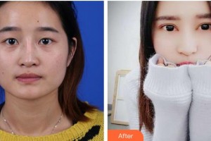 亳州雷賽眼科醫(yī)院周湘紅整形價格表附眼部手術(shù)案例展示