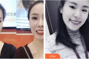 亳州康美口腔醫(yī)院李洋洋整形價格表附牙齒隱形矯正案例展示