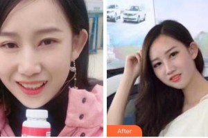 亳州嚴(yán)秀口腔診所嚴(yán)秀整形價格表附牙齒隱形矯正案例展示