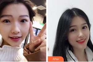 亳州郭琳口腔診所馮苗苗整形價格表附牙齒矯正案例展示