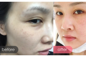 廣州市第十二人民醫(yī)院整形美容科何榮國(guó)整形價(jià)格表附皮膚微秒案例展示