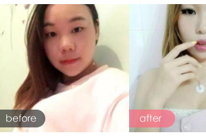 廣州慕美醫(yī)療美容醫(yī)院韓淼整形價格表附女性私密案例展示