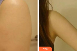 廣州軍美整形醫(yī)院王娜整形價(jià)格表附吸脂瘦手臂案例展示