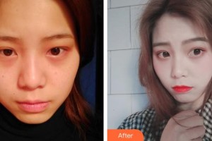 池州佳美皮膚美容醫(yī)院吳勤整形價(jià)格表附激光祛斑案例展示