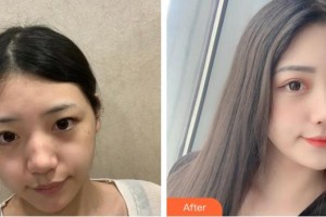 池州佳美皮膚美容醫(yī)院章巧云整形價(jià)格表附激光祛斑案例展示