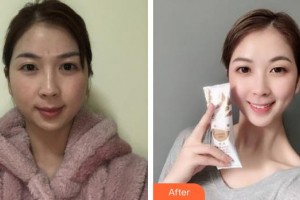 池州佳美皮膚美容醫(yī)院吳成安整形價(jià)格表附激光祛斑案例展示