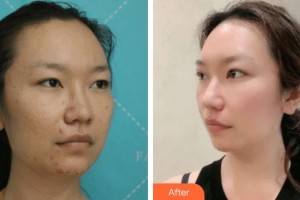 池州愛(ài)爾眼科醫(yī)院汪勝利整形價(jià)格表附切開(kāi)雙眼皮案例展示