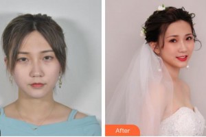 池州愛(ài)爾眼科醫(yī)院黃志強(qiáng)整形價(jià)格表附眼部綜合案例展示