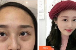 池州愛(ài)爾眼科醫(yī)院陳祥雷整形價(jià)格表附內(nèi)切祛眼袋案例展示