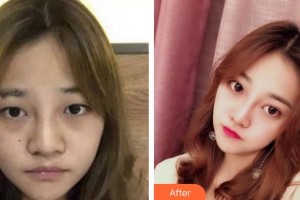 池州愛(ài)爾眼科醫(yī)院童曉陸整形價(jià)格表附切開(kāi)雙眼皮案例展示