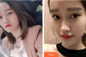 池州博雅口腔門診部汪琦霞整形價(jià)格表附牙齒隱形矯正案例展示