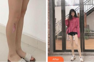 宣城人民醫(yī)院燒傷整形科章社民整形價(jià)格表附激光祛疤案例展示