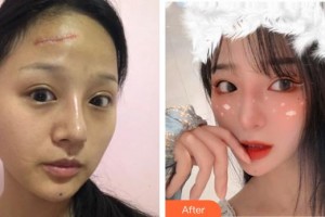 宣城中心醫(yī)院燒傷整形科金瑞整形價(jià)格表附激光祛疤案例展示