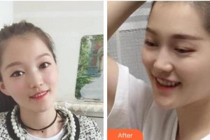 宣城為民口腔門診部呂敏整形價(jià)格表附金屬托槽矯正案例展示