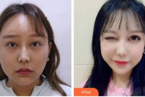 宣城眼科醫(yī)院吳志兵整形價(jià)格表附眼部綜合案例展示