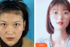 宣城眼科醫(yī)院楊國(guó)棟整形價(jià)格表附內(nèi)切祛眼袋案例展示