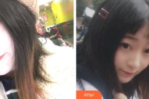 宣城為民口腔門診部李學(xué)峰整形價(jià)格表附金屬托槽矯正案例展示