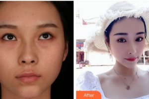 宣城康視五官科醫(yī)院眼科王倫斌整形價格表附切開雙眼皮案例展示