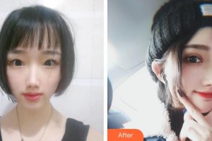 宣城康視五官科醫(yī)院眼科許剛整形價格表附切開雙眼皮案例展示