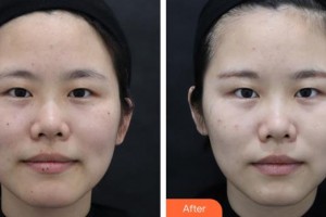 浙江綠城醫(yī)院整形美容中心金亦多整形價(jià)格表附激光祛斑案例展示