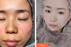 浙江大學(xué)醫(yī)學(xué)院附屬第二醫(yī)院整形科陶志平整形價(jià)格表附祛斑案例展示